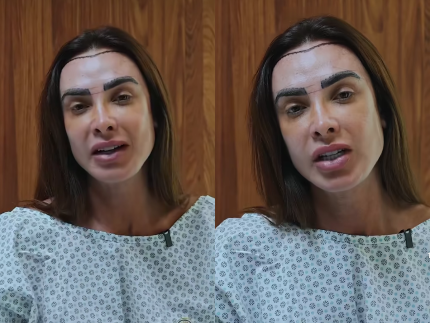 Nicole Bahls realiza transplante capilar para diminuir a testa: “Vou ficar feliz e cabeluda”